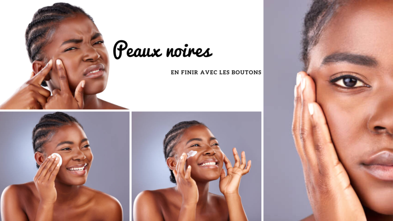 Peaux noires en finir avec les boutons